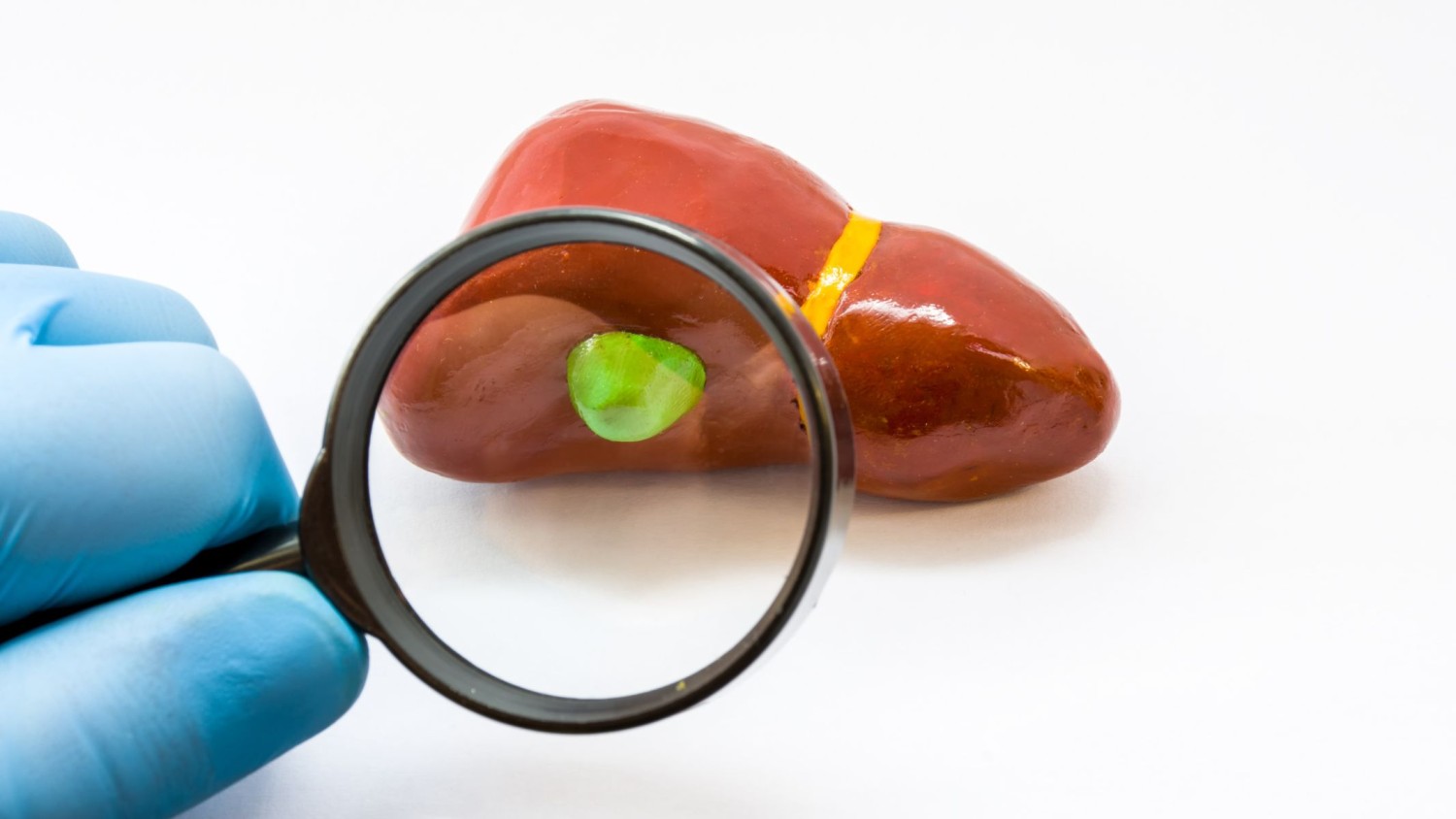 Gan nhiễm mỡ và polyp túi mật: Hiểu đúng mối liên quan và cách xử trí an toàn