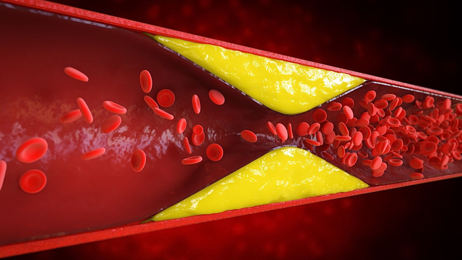 Máu nhiễm mỡ và gan nhiễm mỡ: Sự khác nhau, mối liên quan và cách phòng ngừa